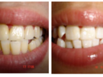 WhiteTeeth.ie €69